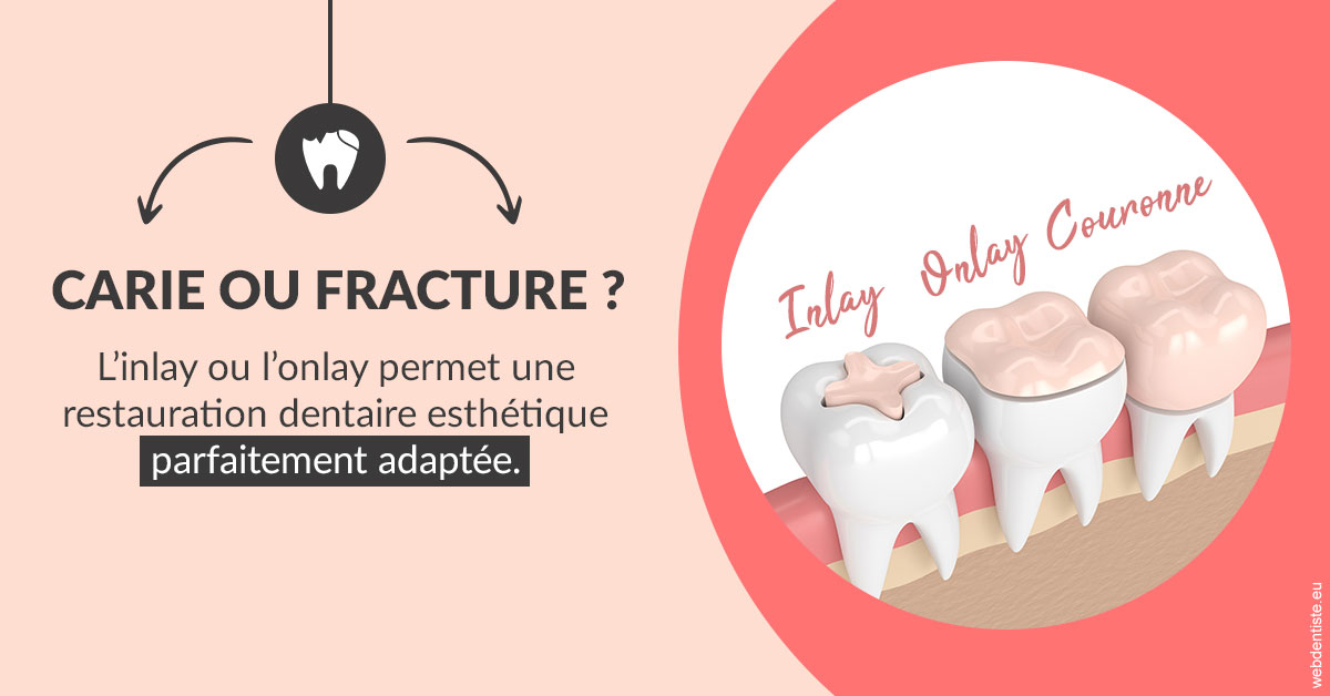 https://selarl-cabinet-dentaire-sevain.chirurgiens-dentistes.fr/T2 2023 - Carie ou fracture 2