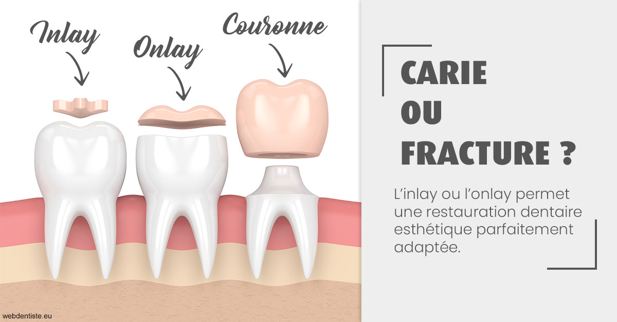 https://selarl-cabinet-dentaire-sevain.chirurgiens-dentistes.fr/T2 2023 - Carie ou fracture 1
