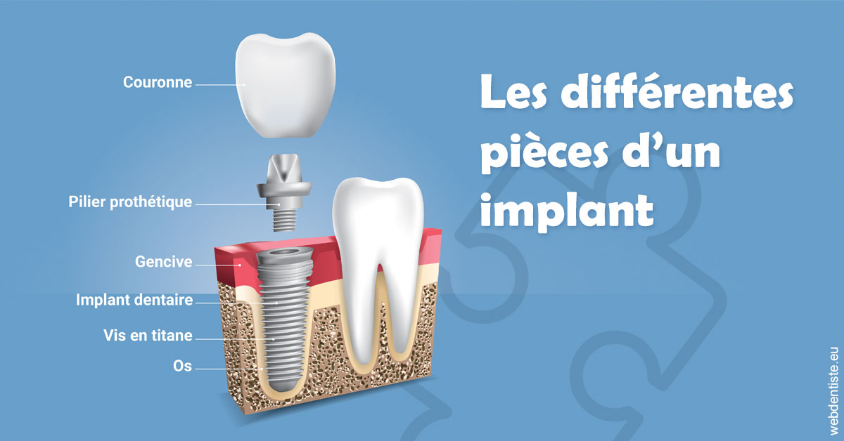 https://selarl-cabinet-dentaire-sevain.chirurgiens-dentistes.fr/Les différentes pièces d’un implant 1